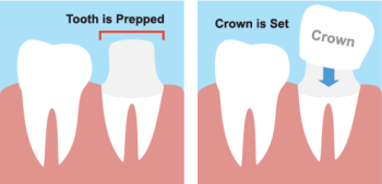 Saxonburg dentist, Dr. Roger M. Sepich at Saxonburg Dental Care, shares all you need to know about dental crowns and how they can restore your smile in form and function.